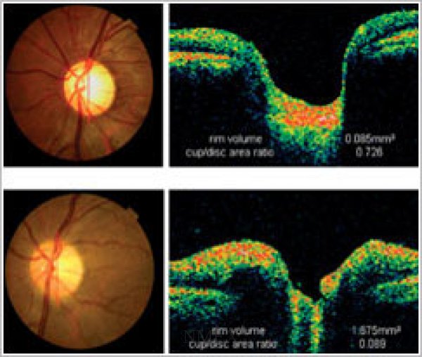OCTimagesGlaucoma