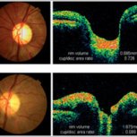 OCTimagesGlaucoma